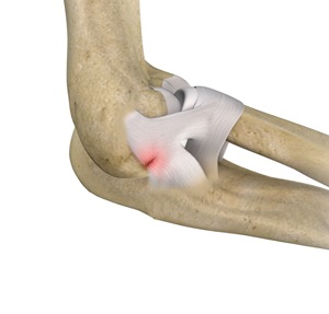 Ulnar Collateral Ligament (UCL) Injury pic