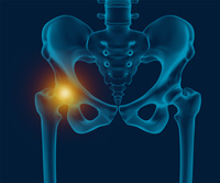 Hip Pain pic
