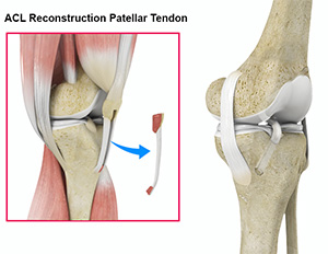 Anterior cruciate ligament (ACL)