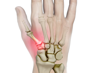 Arthritis of the Thumb