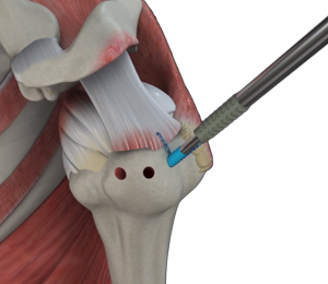 Arthroscopic Surgery