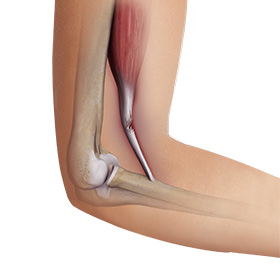 Biceps Tendon