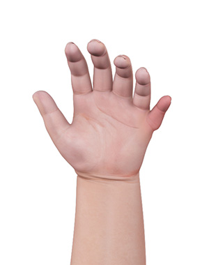 Congenital Defects