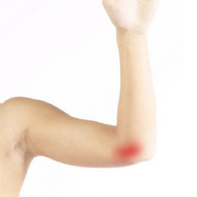 Cubital Tunnel Syndrome