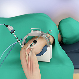 Elbow Arthroscopy