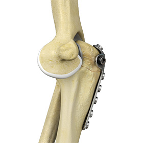 Elbow Fracture Reconstruction