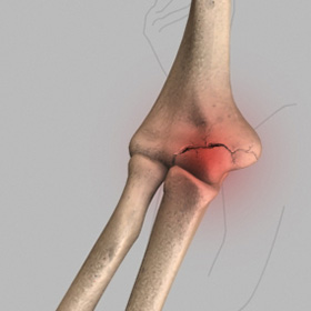 Elbow Fracture
