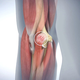 Golfer's Elbow