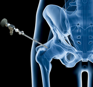 Hip arthrocopy