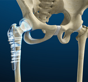 Hip Fracture Surgery
