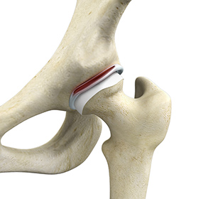 Hip Labral Repair