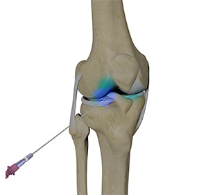 Intra-articular knee injections