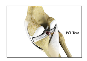 Posterior Cruciate Ligament