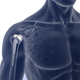 Reverse Shoulder Replacement