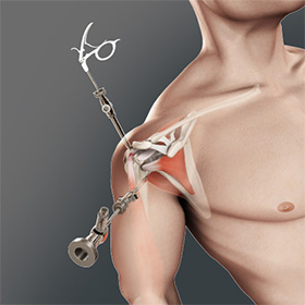 Shoulder Arthroscopy