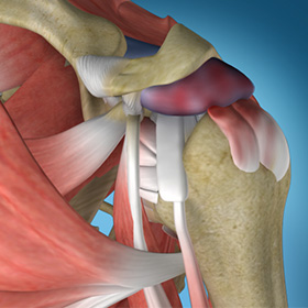Shoulder Impingement