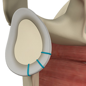 Shoulder Labrum Reconstruction
