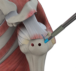 Shoulder Stabilization