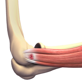 Tennis Elbow