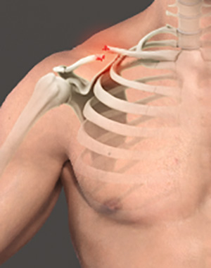 Clavicle Fracture Image
