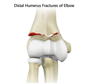 Distal Humerus Fracture