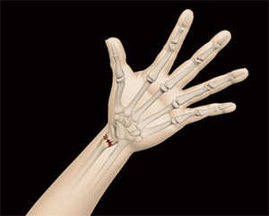 Distal Radius Fracture Image