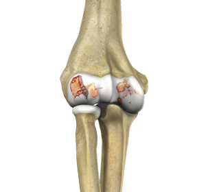 Arthritis of the Elbow