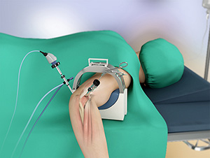 Elbow Arthrocopy Image