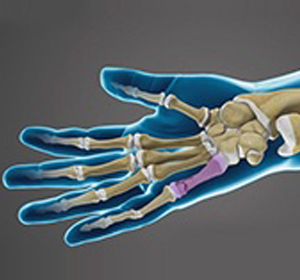 Hand and Finger Fracture