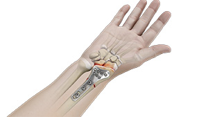 ORIF of the Distal Humerus Fractures Image
