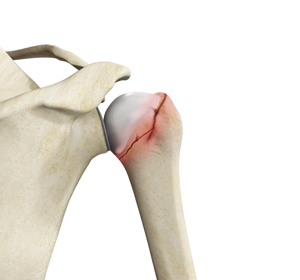 Fracture of the Shoulder Blade Image