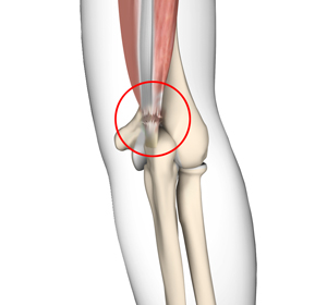 Triceps Injuries