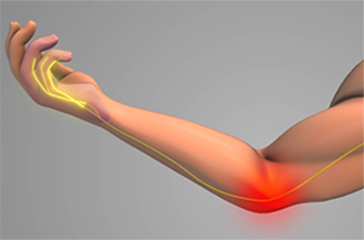 Cubital Tunnel Syndrome: A Growing Diagnosis and Why It's Often Confused with Carpal Tunnel