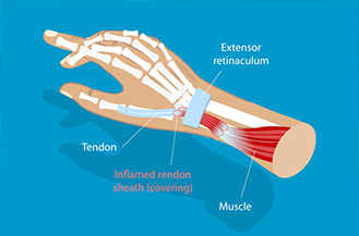 De Quervain’s Tenosynovitis: Wrist Pain from Repetition and Overuse