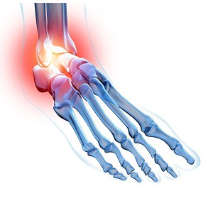 Ankle Pain