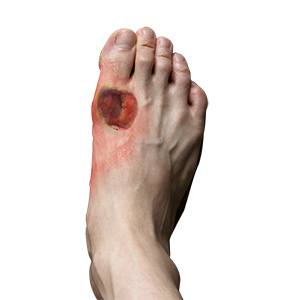 Diabetic Foot Conditions