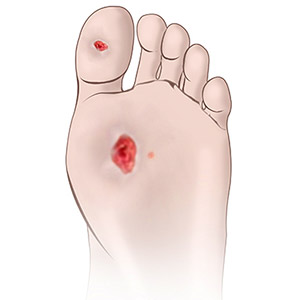 Diabetic Wound Management