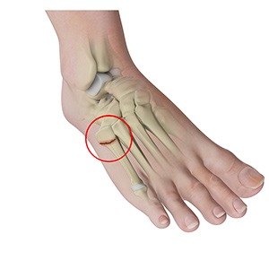 Foot Fracture