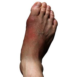 Foot Infections