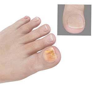 Fungal Nails