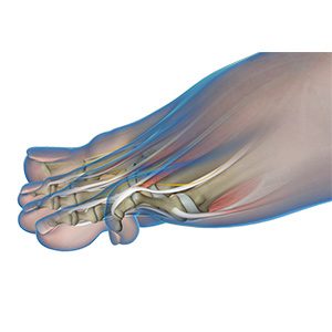Hammertoe
