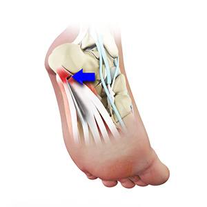 Heel Surgery