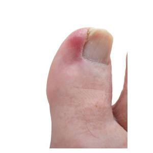 Ingrown Toenail