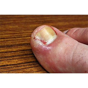 Toenail Conditions