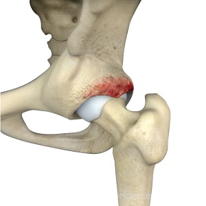 Acetabular Pincer Deformity pic