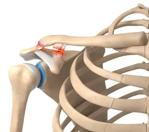Acromioclavicular Joint Sprains pic