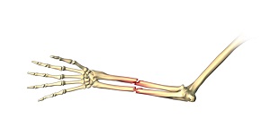 Adult Forearm Fractures pic