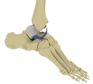 Ankle Dislocation