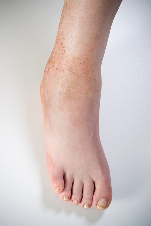 Ankle Impingement pic