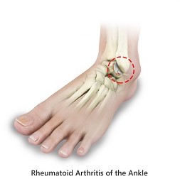 Ankle Rheumatoid Arthritis pic